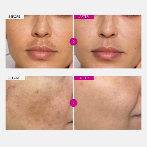 Melasma Fade Cream