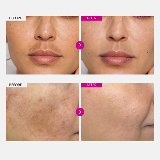 Melasma Fade Cream