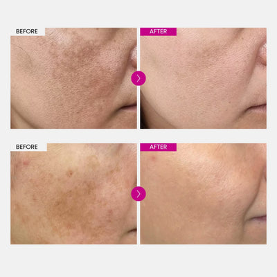 Fade Your Melasma With Arbutin 7% + Tranexamic Acid 4%