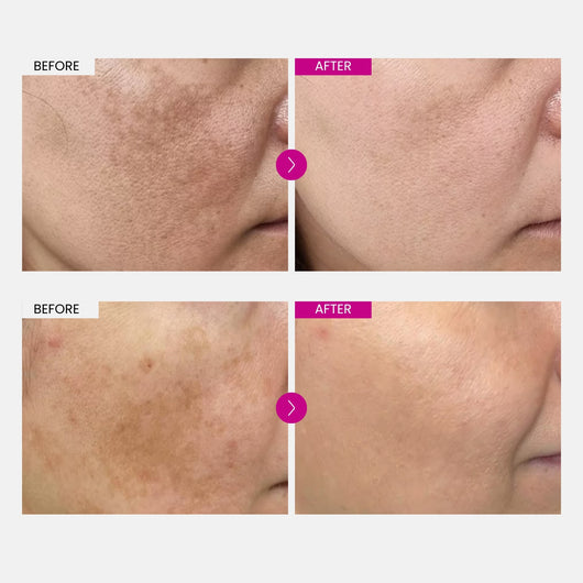 Fade Your Melasma With Arbutin 7% + Tranexamic Acid 4%